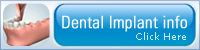Dental Implant Info button